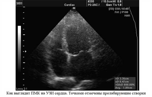 Как выглядит ПМК на УЗИ сердца. Точками отмечены пролабирующие створки