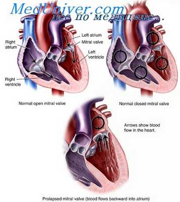 пролапс митрального клапана