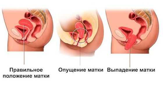 Опущение и выпадение матки