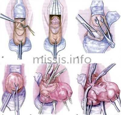 Кольпорафия половых органов