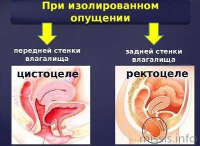 Опущение задней и передней стенки