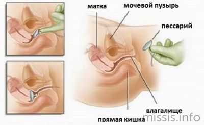 Как ставят пессарий