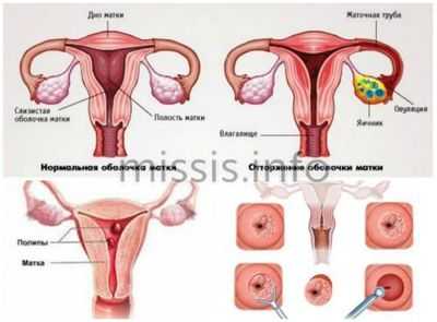 Заболевания матки женщины