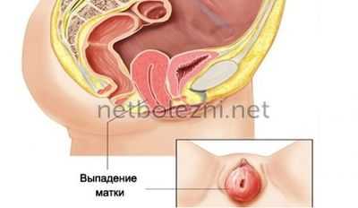 Как выглядит опущение влагалища