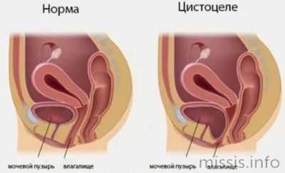 Пролапс мочевого пузыря