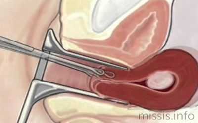Операция при выпадении