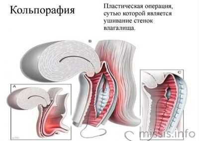 Пластическая операция кольпорафия