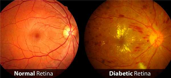 непролиферативная диабетическая ретинопатия
