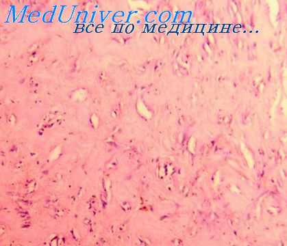 фиброматоз шеи