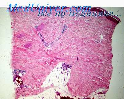 пролиферирующий миозит