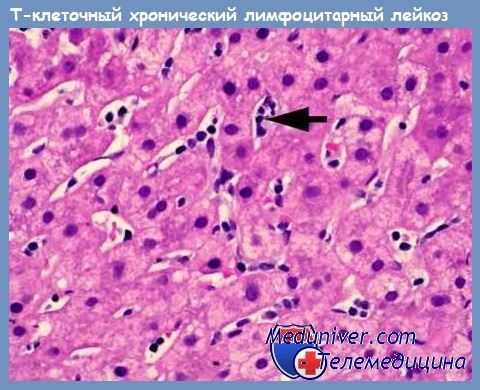 Т-клеточный хронический лимфоцитарный лейкоз