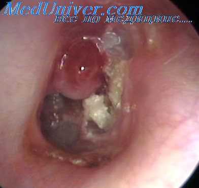 хронический эпитимпанит