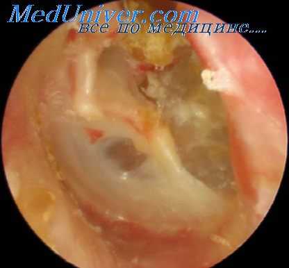 лечение эпитимпанита