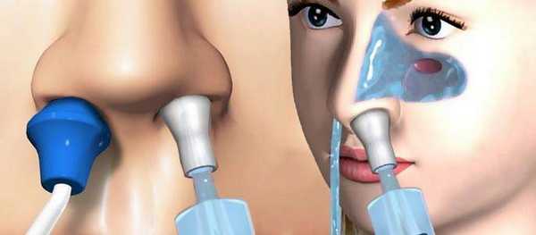 принцип метода Проетца