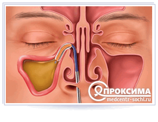 Промывание околоносовых пазух и носоглотки