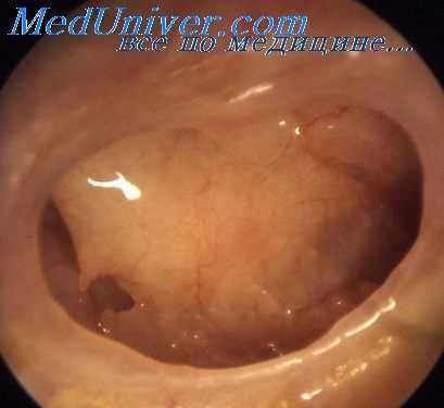 промывание слухового прохода