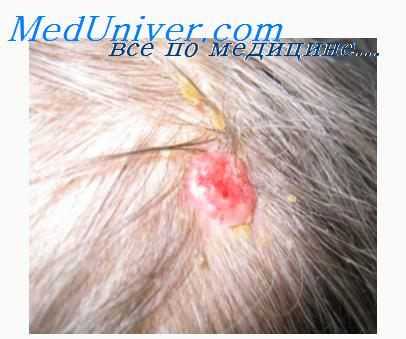 канцерогены