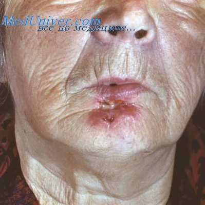 опухолевый рост