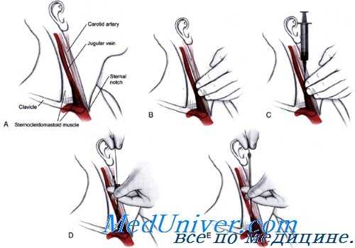 интракаротидное введение лекарств
