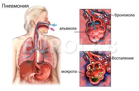 пневмония