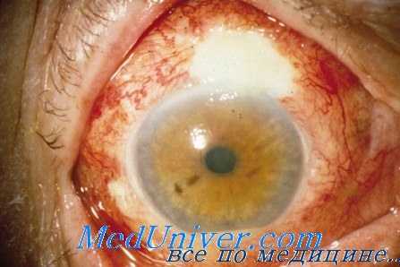 введение антибиотиков при эндофтальмите
