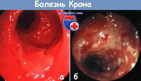Толсткая кишка при болезни Крона