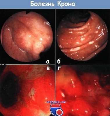 Толсткая кишка при болезни Крона