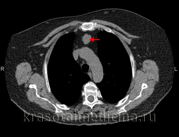 Рак средостения