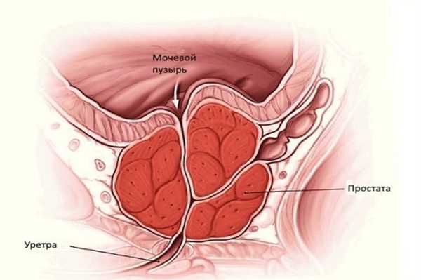 Простатит