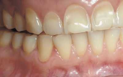 Причины заболевания - Стоматология «Линия Улыбки»