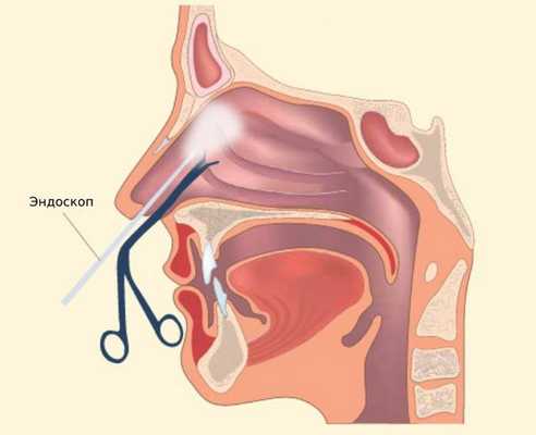 FESS-хирургия