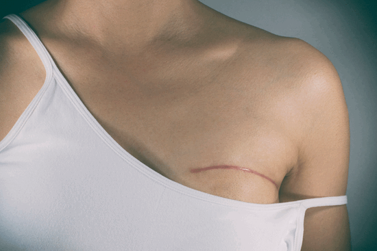 Мастэктомия: нюансы проведения и восстановления
