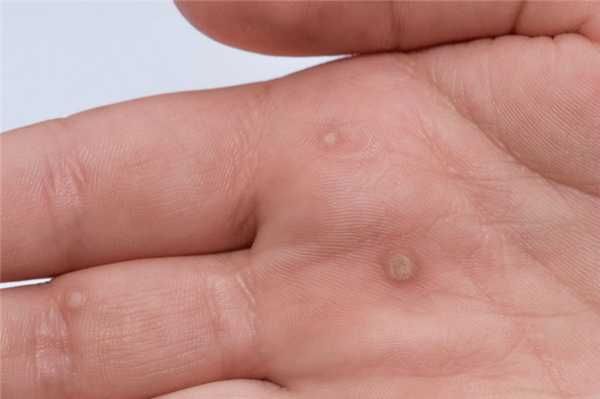 Плоская бородавка