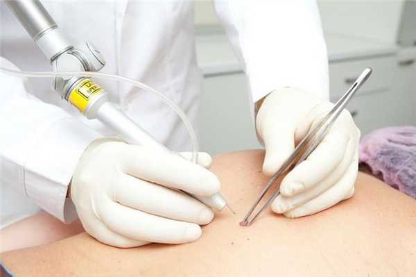 Удаление бородавок