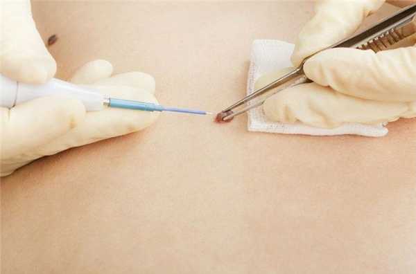 Лечение бородавок