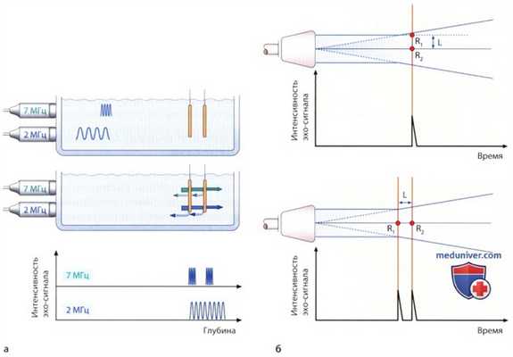 Пространственное и временное разрешение эхокардиографии (ЭхоКГ)