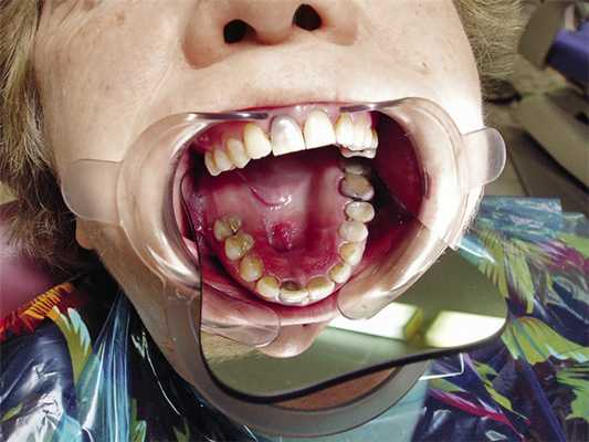 Рис. 2. Клиническая картина верхней челюсти (до операции).