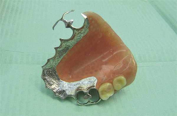 Рис. 8. Готовый съемный протез-обтуратор.