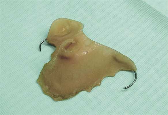 Рис. 3. Вид старого протеза.