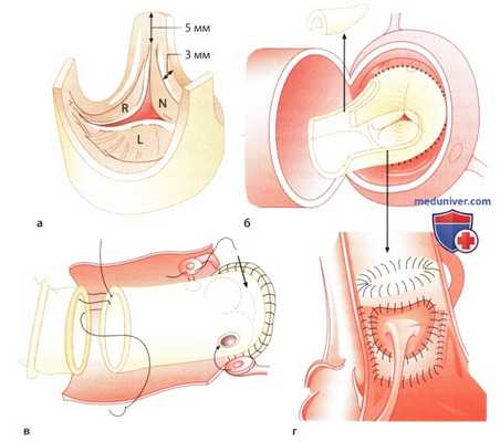 Биологические протезы клапанов сердца