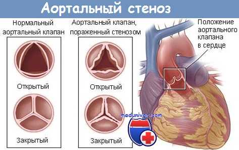 Аортальный стеноз