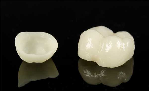 Фото керамических вкладок