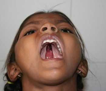 дефект неба