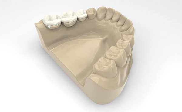 Фото несъемных протезов