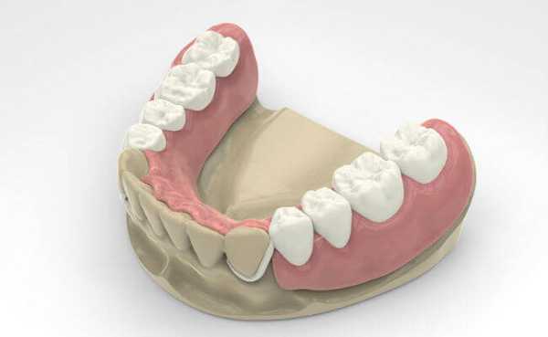 Фото съемного протеза