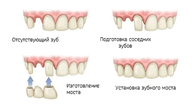 Инфографика как устанавливают мост на три зуба