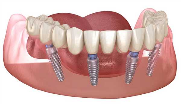 Мост на 4 имплантах на нижней челюсти