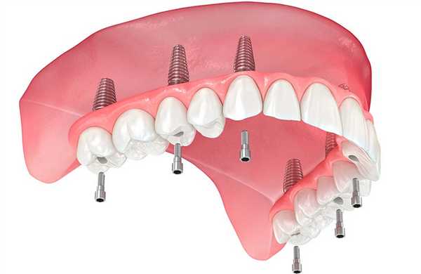 Мост на верхней челюсти по протоколу все-на-6