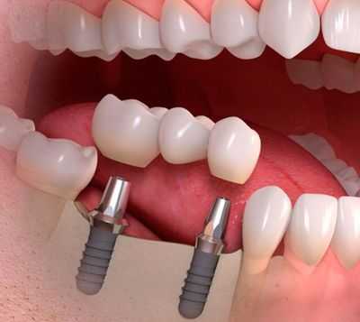 Мост на имплантах