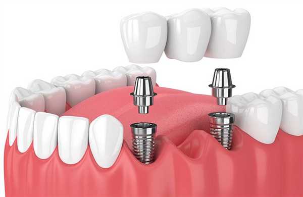 Мост с опорой на двух имплантах